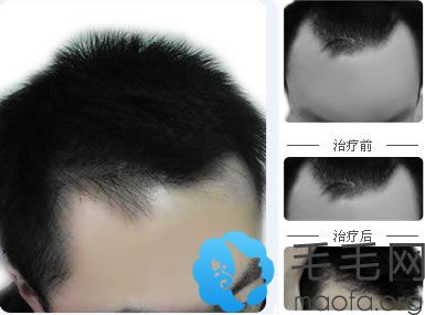 西安碧莲盛植发为男性前额M型脱发患者植发效果