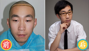 北京熙朵植发案例 男性前额光秃植发效果