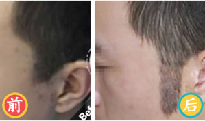 北京熙朵植发男性鬓角移植案例