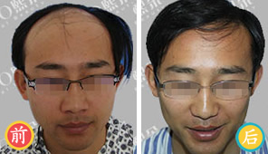 北京熙朵为前额秃顶男性患者实施植发手术