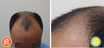 秃顶男子在中国台湾瑞丝得接受植发手术