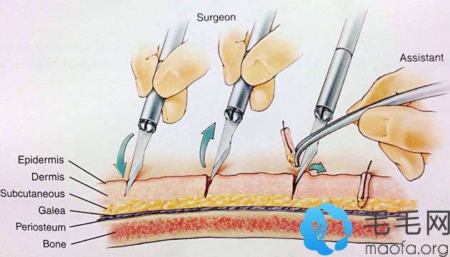 毛发移植术中提取毛囊流程