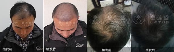 植发手术治疗脱发的案例效果