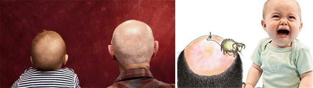 男子脱发90%和基因有关，外孙遗传外公发型