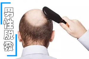别不把脱发当回事 男性治疗脱发的八大误区