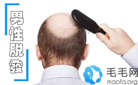 男性治疗脱发的八大误区