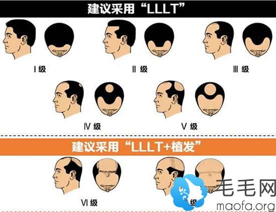 LLLT适用于中早期脱发患者