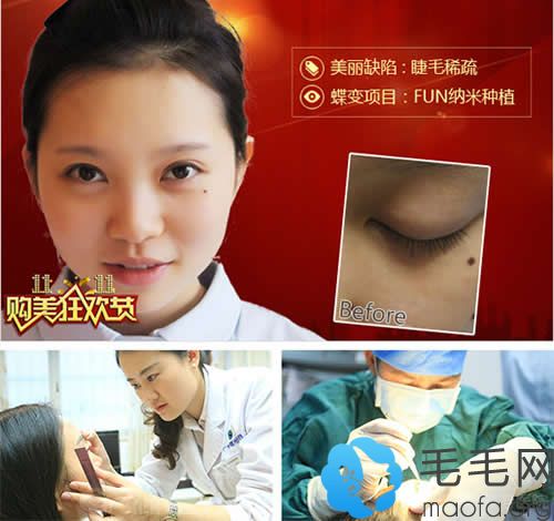 广州曙光护士种植睫毛效果图