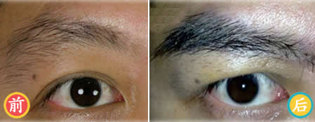 中国台湾dr.liu植发中心植眉案例 男性植眉400毛效果