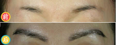 中国台湾dr.liu植发中心植眉案例 女性植眉250毛手术效果