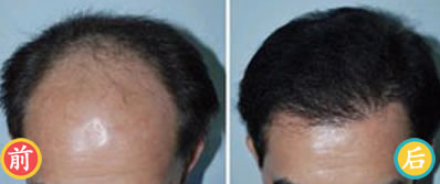 烟台华怡植发真实案例 男性六级脱发的治疗效果