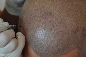 SMP头皮纹发帮你解决植发失败及无毛囊可移植的绝境