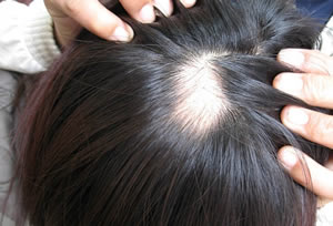 十大常见年轻男性脱发的原因 从毛发根源解决脱发问题