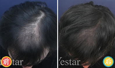 北京艺星植发头顶植发案例 影响植发效果三大因素
