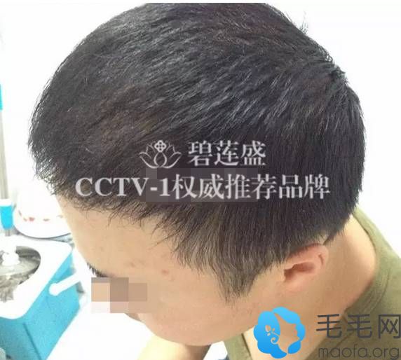 杨志祥M型植发术后7个月，基本能掩盖脱发