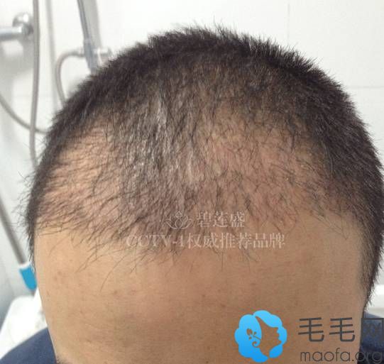 碧莲盛杨志祥M型植发术后2个月术后两个月，头发还处于脱落期