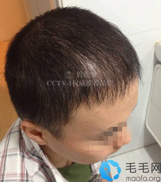 杨志祥M型植发术后2个月术后5个月，头发开始越来越浓密