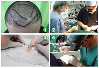 植发手术过程