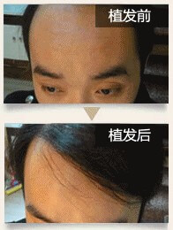 南昌宏昌：头发种植案例