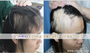 北京熙朵疤痕植发案例 女性疤痕脱发种植头发效果