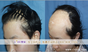 北京熙朵疤痕植发案例 男性大面积烧伤植发效果