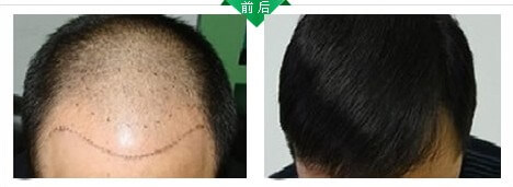 杭州杭城皮肤病研究院 头发种植案例