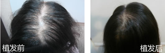 女性植髮案例-中顶秃植髮十个月后