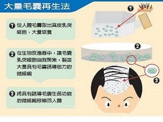 脱发的治疗方法：技术再生毛囊