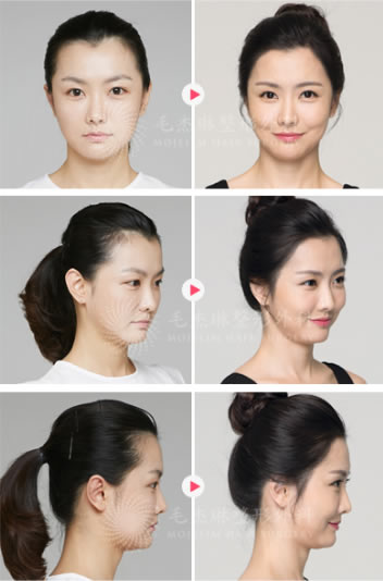 韩国毛杰琳女性M字形发际线矫正案例前面和侧面效果
