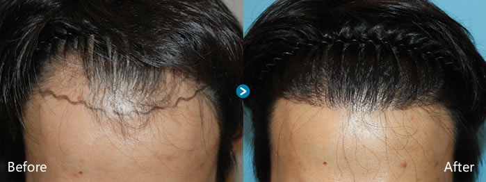 韩国毛杰琳毛发移植手术前后照片