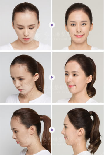 韩国毛杰琳毛发移植中心女性发际线矫正术后正面侧面效果