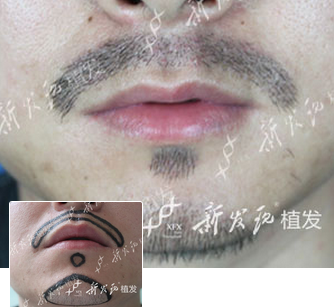广州新发现胡须种植案例