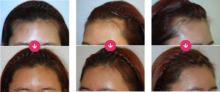 VELLUS毛发移植术进行发际线矫正后的效果