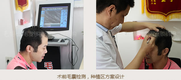 毛博士为陈先生进行术前毛囊检测以及种植区方案设计