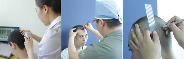 韩国多娜为患者做术前毛囊检测及术前设计
