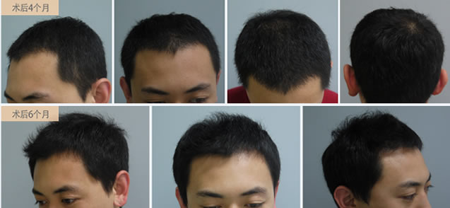 韩国为患者进行非切开毛发移植后4个月及6个月的效果