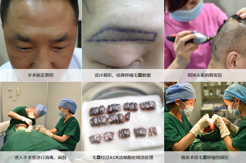广州荔湾区人民医院毛发移植植眉手术过程