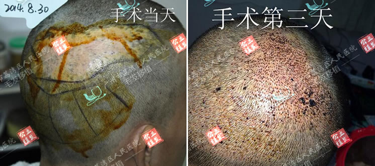 在广州人民医院植发中心手术当天和第三天的照片