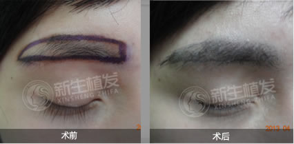 深圳仁爱医院新生植发中心女性植眉前后效果对比