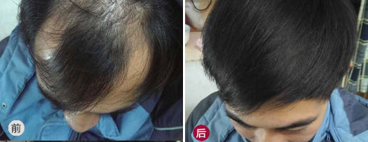 深圳仁爱医院新生植发为脂溢性脱发患者王先生植发前后效果