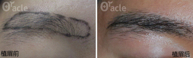 韩国奥拉克毛发移植中心植眉手术案例前后效果对比