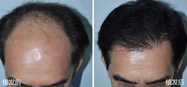 广西南宁华美毛发种植中心男性种植头发案例前后效果对比