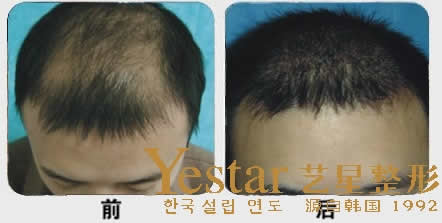 上海艺星毛发移植中心男性成功植发前后效果对比