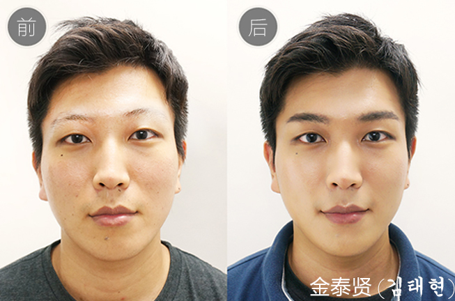 上海艺星毛发移植中心男性种植眉毛前后效果对比