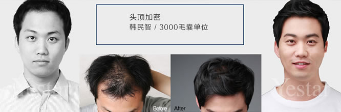 上海艺星毛发移植中心男性头发加密手术前后效果对比