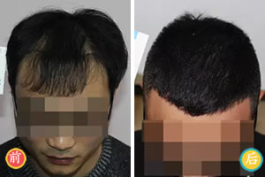 上海雍禾植发L点阵植发4个月见效 头顶脱发稀疏植发案例