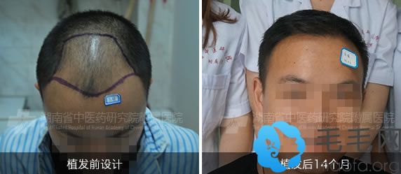 湖南中医院植发科种植头发案例图