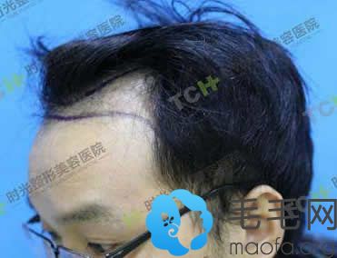 重庆时光植发中心为陈先生设计的植发方案