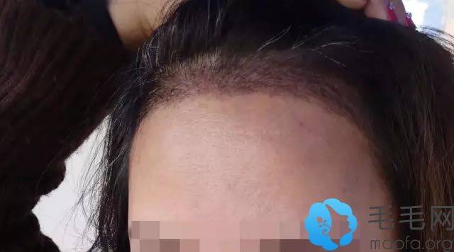 女生种植发际线手术1个月的样子