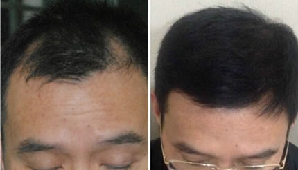 苏州发友陈先生选择圣爱毛发种植术后两年效果